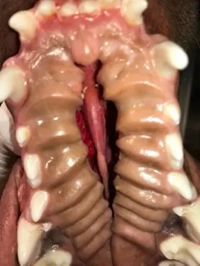 Figure 3: Congenital hard palate cleft