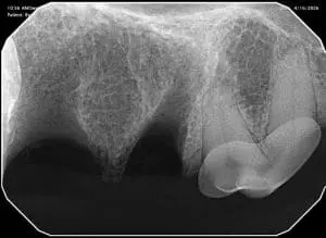 CT image of fixed broken tooth