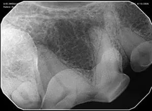CT image before tooth extraction