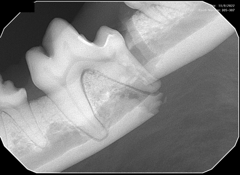 Dental radiograph showing a left mandibular (lower jaw) fracture.