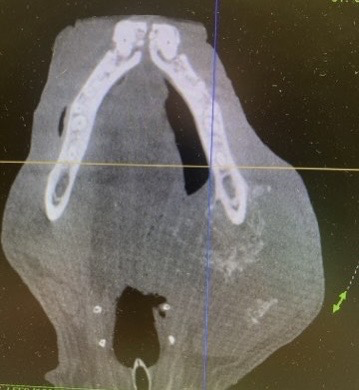 CBCT image showing a mandibular (lower jaw) tumor