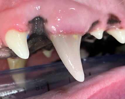 Discolored tooth due to pulpitis