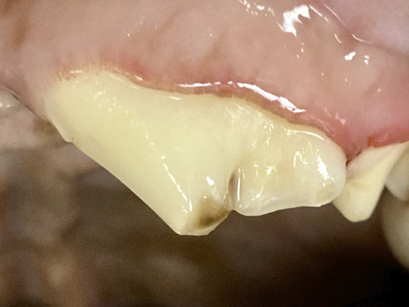 Dentin staining due to a fractured tooth